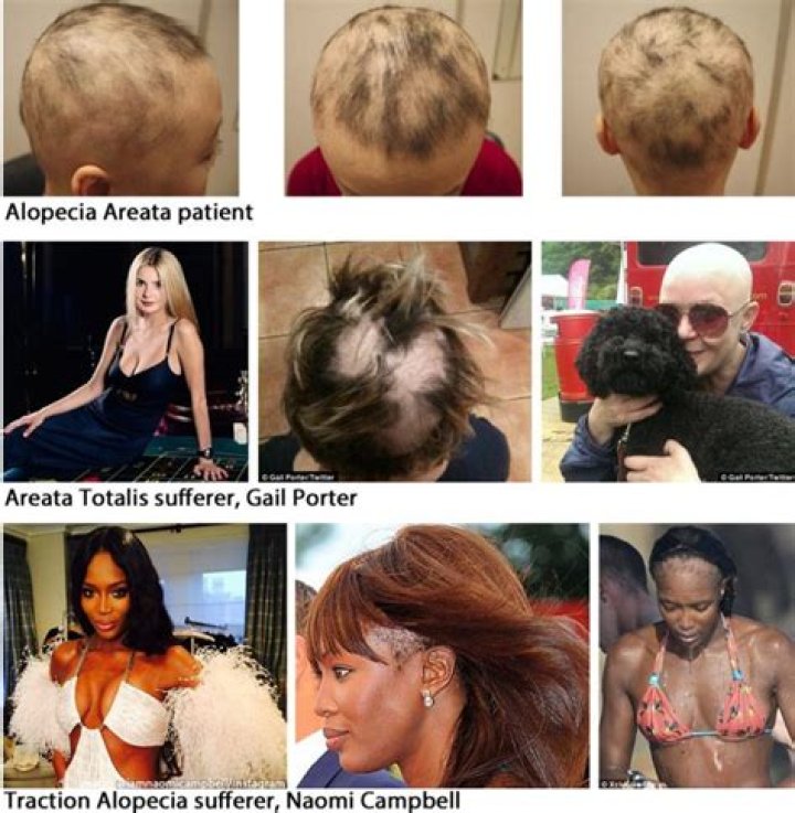 
Does Andi Oliver Has Alopecia? With Hair Pics – Why Is She Bald? 